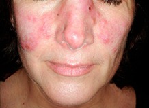 pessoa com manchas vermelhas no rosto